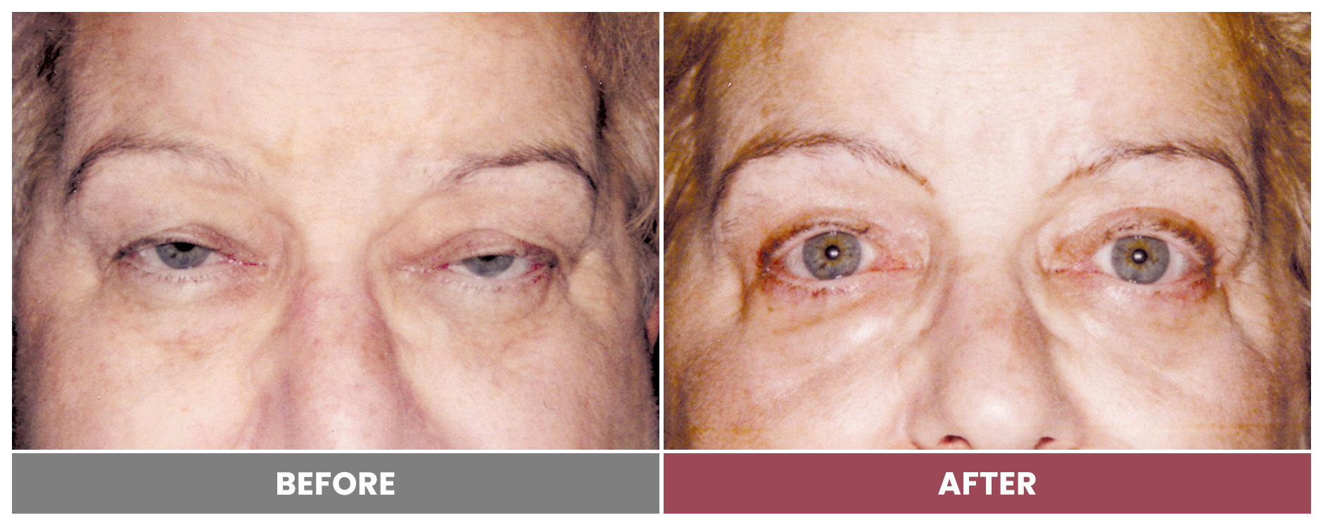 BLEPHAROPLASTY & PTOSIS REPAIR - Case 7